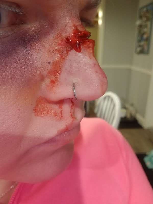 Close-up of a bloody wound on the bridge of the nose
